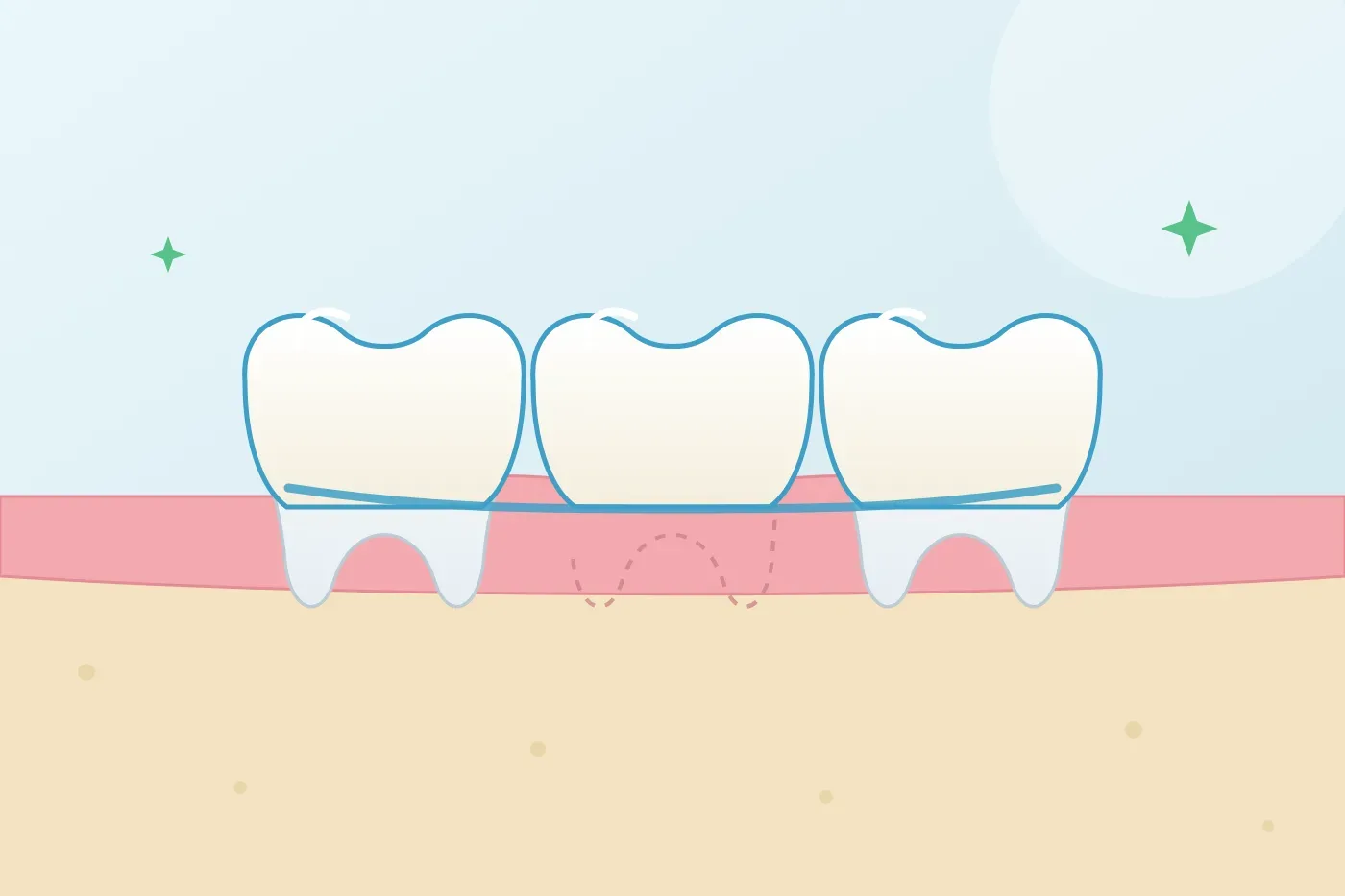 What is a porcelain dental bridge and when should I have one?