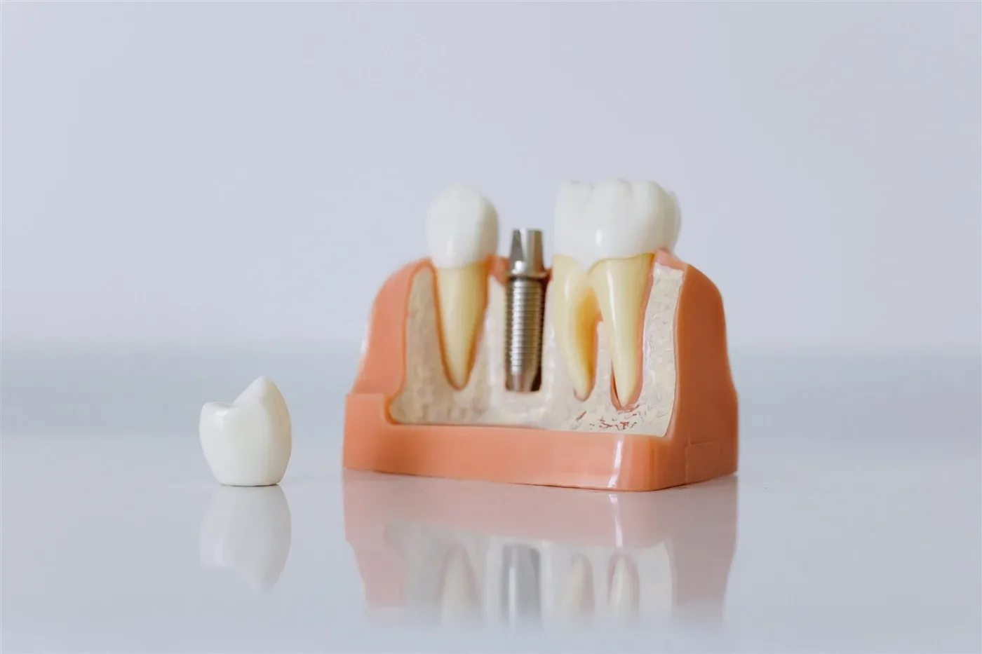 Mô hình cắt ngang nướu và xương có trụ implant, bên cạnh là một mũ răng sứ rời