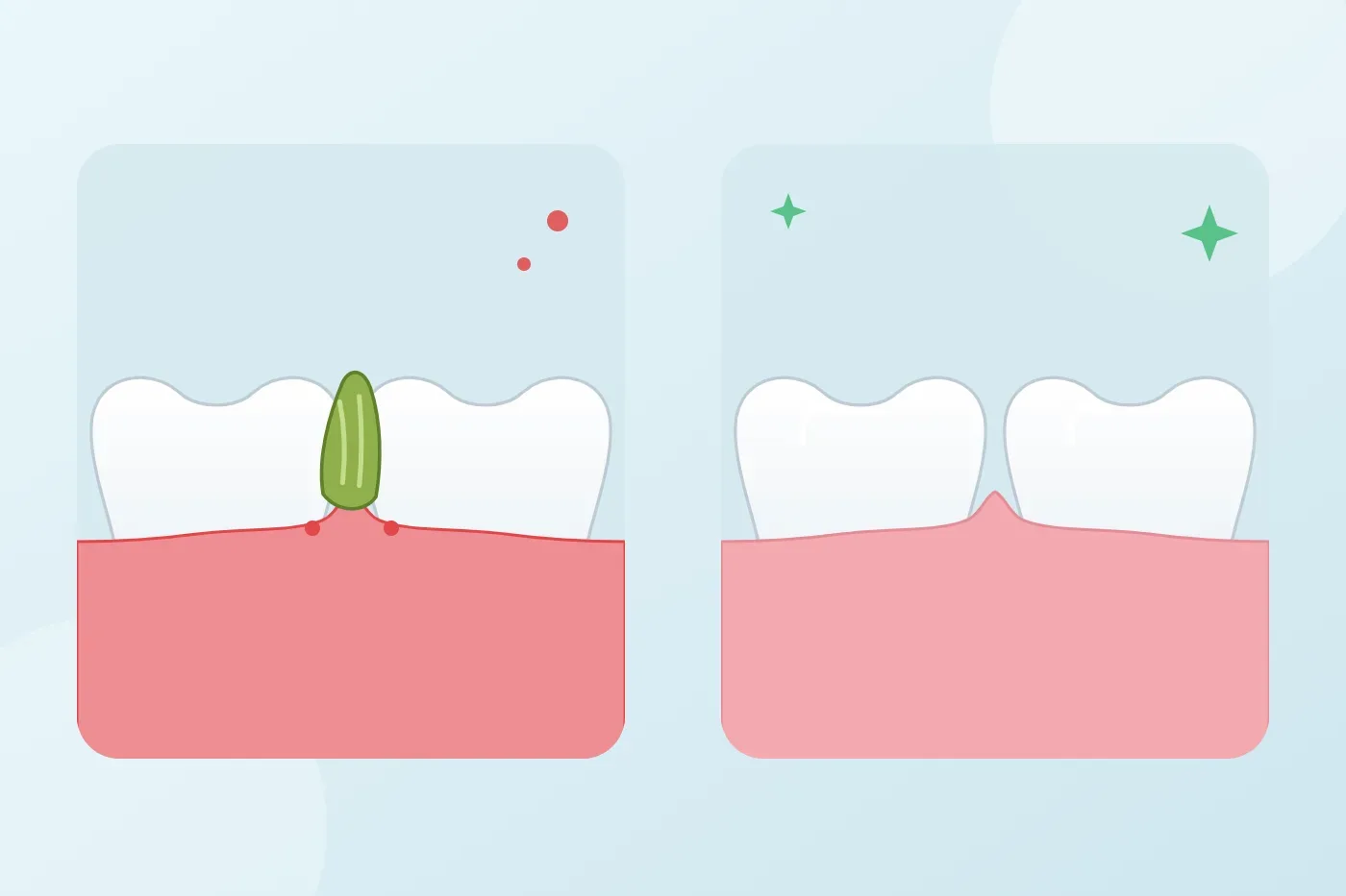 Why does food keep getting stuck between my teeth and what should I do?