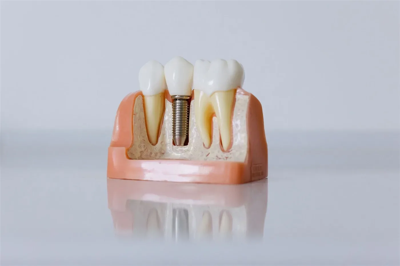 How long after a tooth extraction can you get an implant, and why do some cases need to wait?