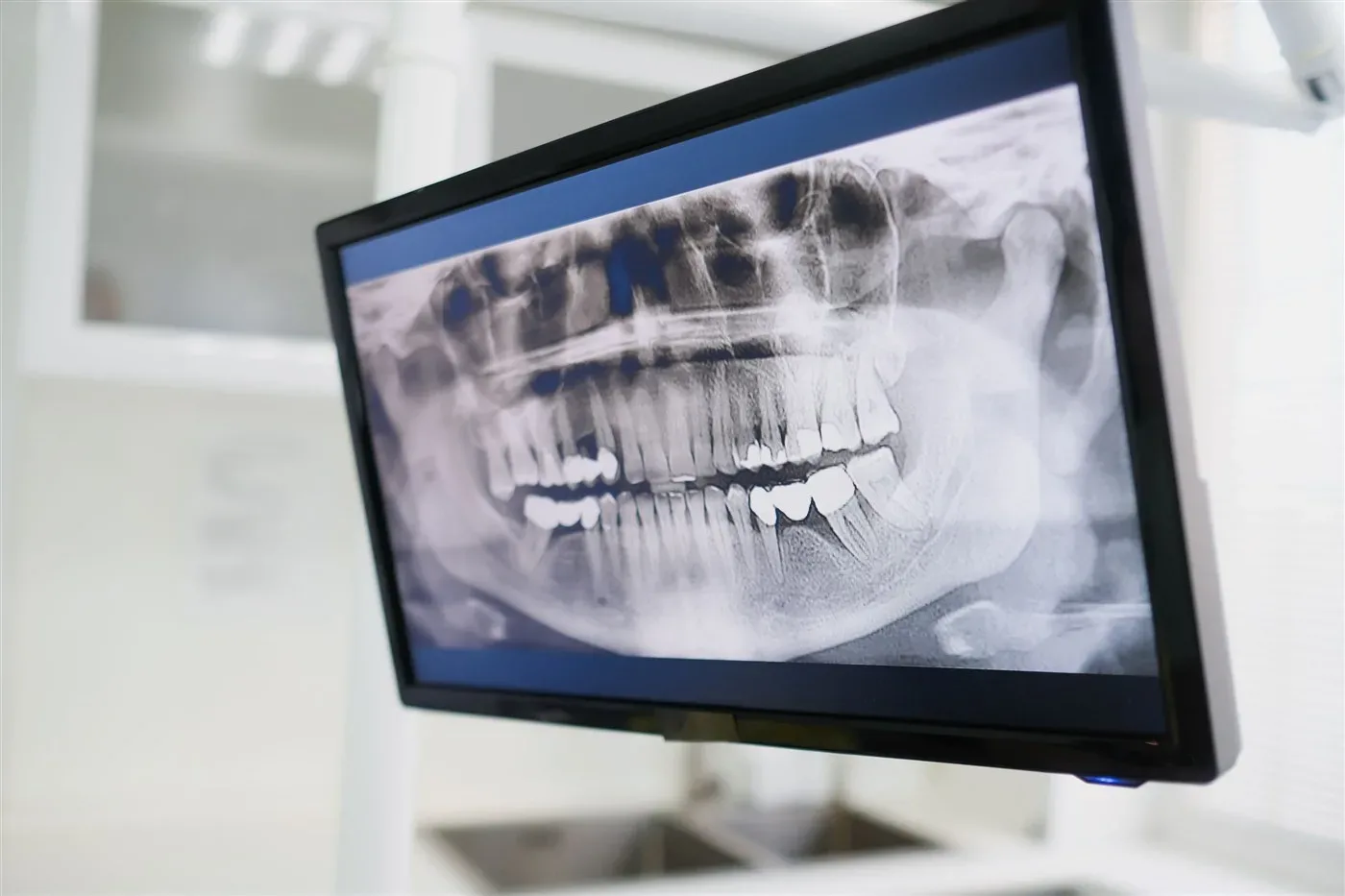 What is the difference between a panoramic and a periapical dental X-ray, and when is each needed?