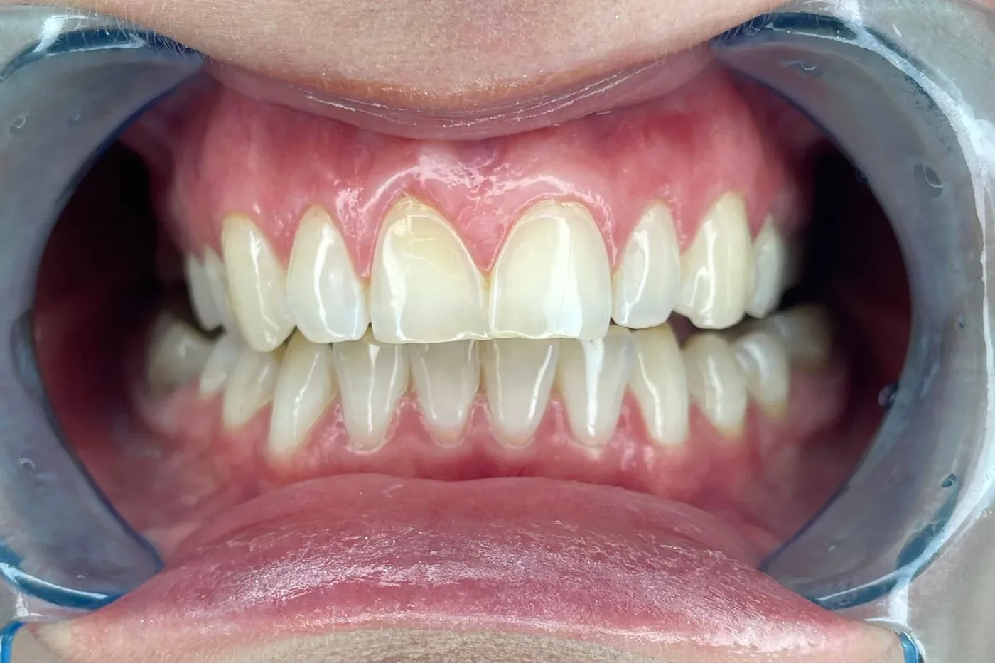 Can a swollen, infected tooth be removed, and when must you wait until the infection settles?