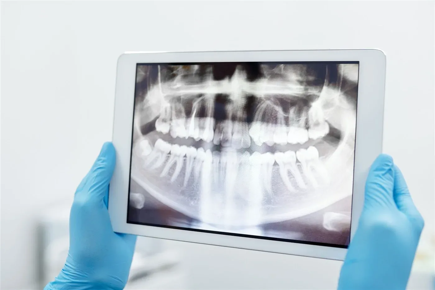 Bác sĩ đeo găng xanh cầm máy tính bảng hiển thị phim X-quang toàn hàm để tìm răng mọc ngầm