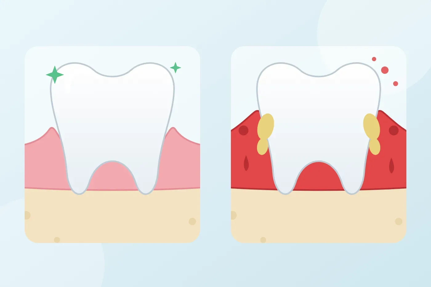 What is gingivitis, why does it happen and does it clear on its own?