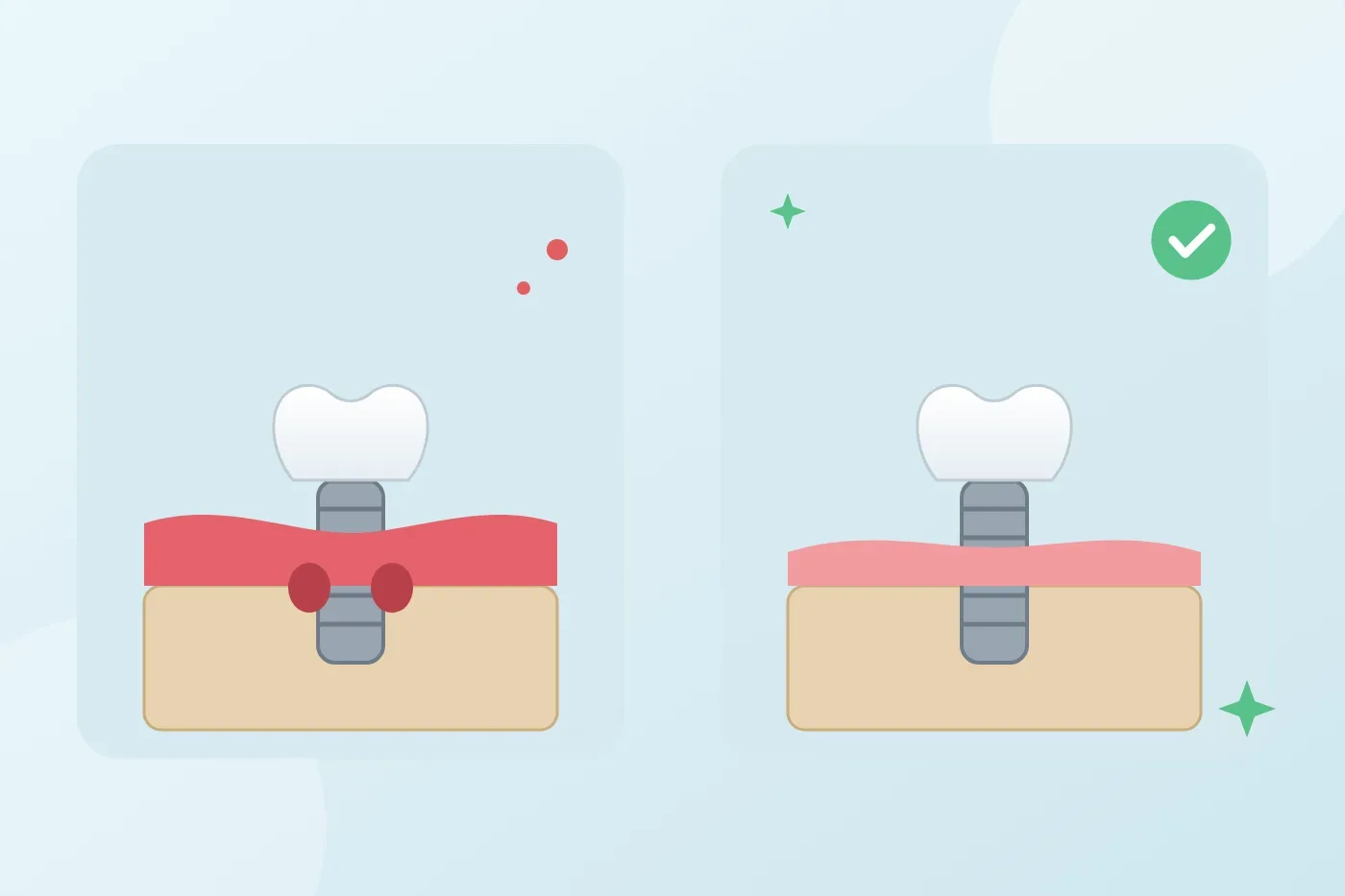 What is peri-implantitis, what are the signs and how can you keep an implant long-lasting?
