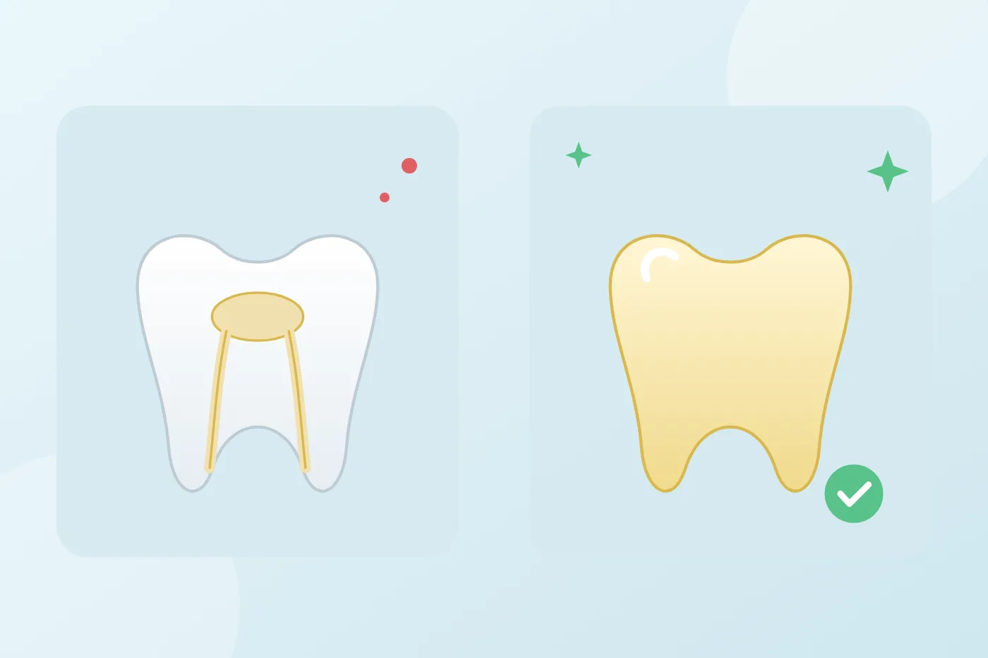 Illustration of a tooth after root canal treatment with the canals filled, compared with a tooth fitted with a protective crown