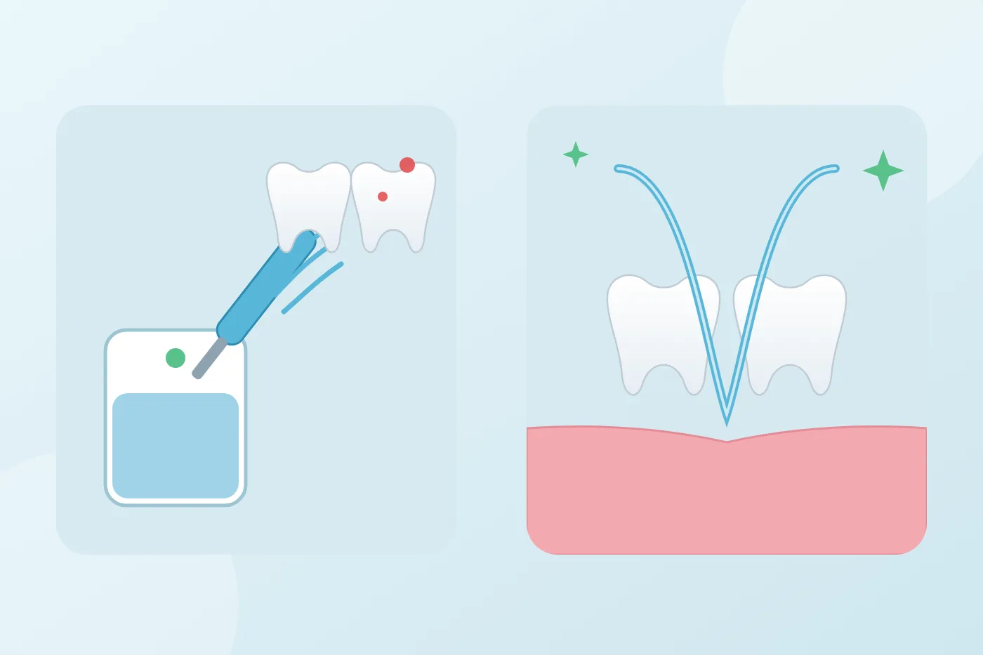 Illustration of a water flosser sending a jet of water between two teeth, compared with a strand of floss going down between teeth