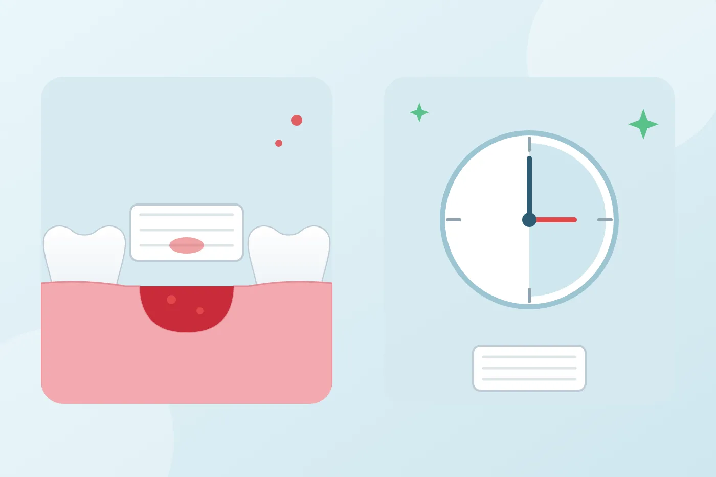 Illustration of a fresh extraction socket with a gauze pad above it, beside a clock showing the time to bite on the gauze