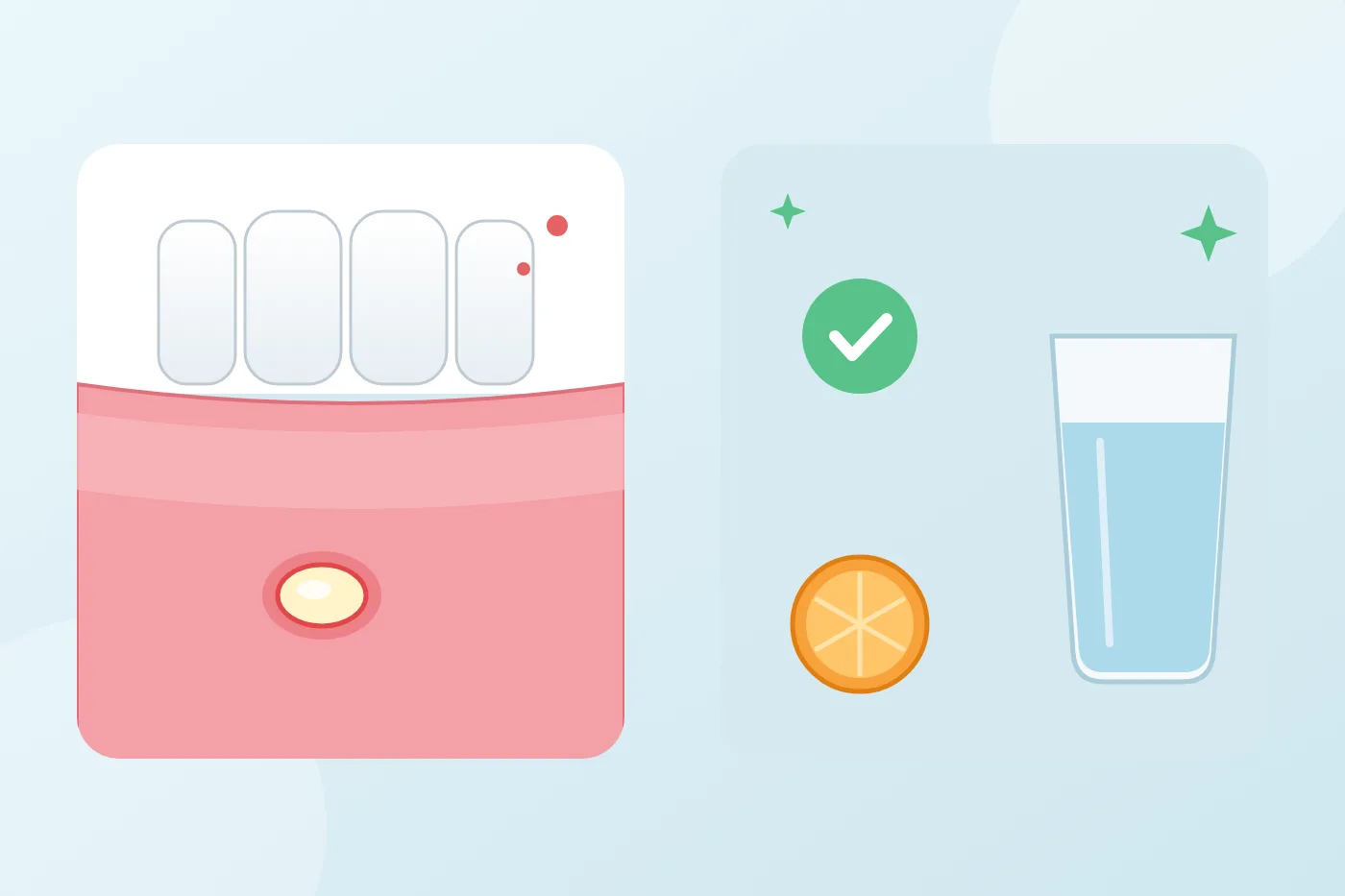 Illustration of a round mouth ulcer with a white-yellow centre and red rim on the inner lip, beside a glass of water and an orange slice