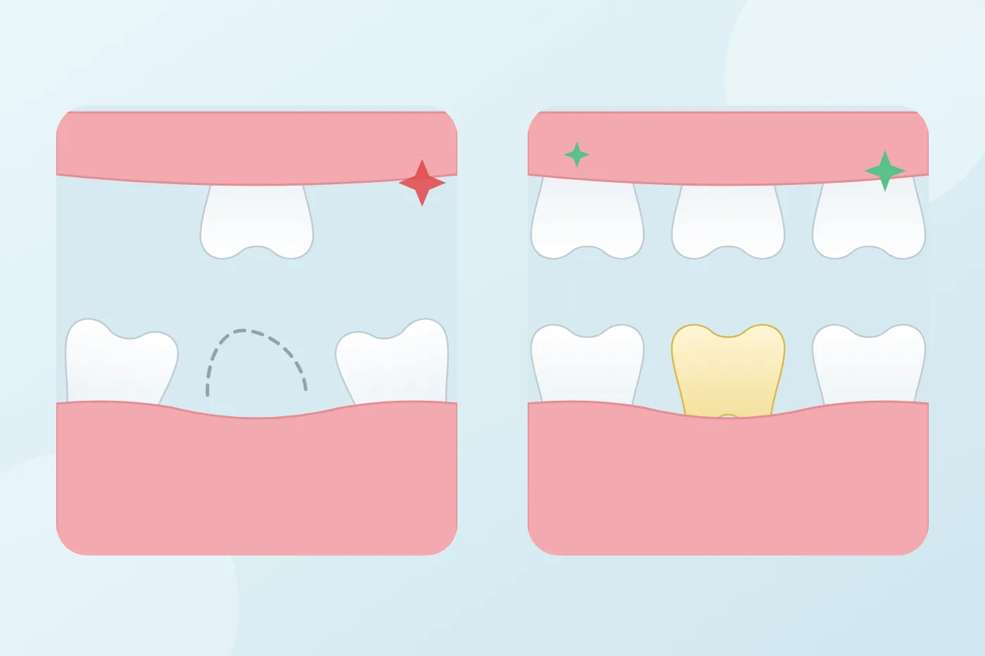 Illustration of a missing molar gap with the neighbouring tooth tilting and the opposing tooth drifting down, compared with a restored bite