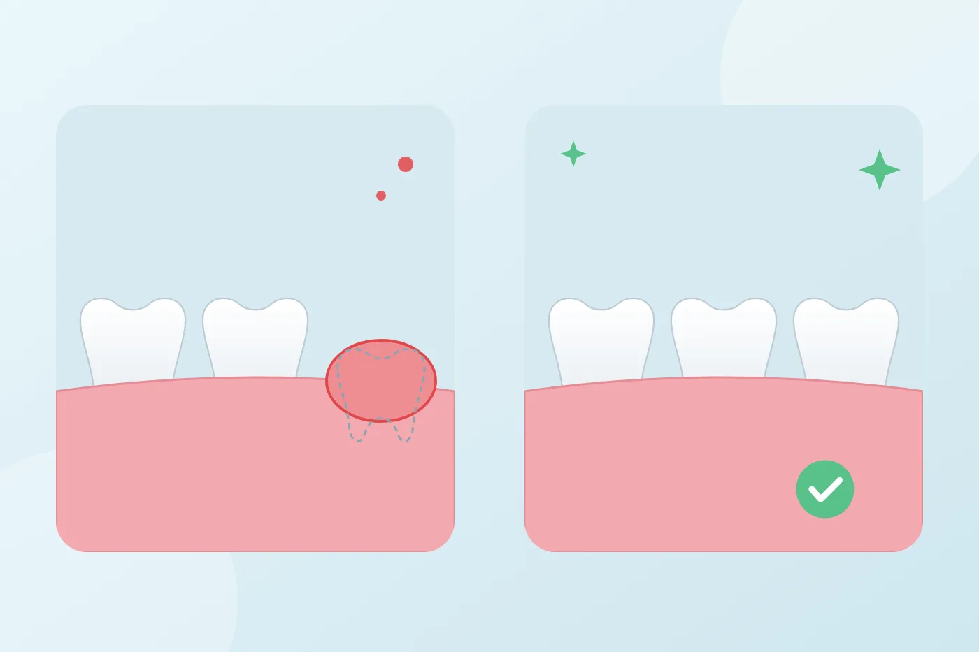 Illustration of a wisdom tooth emerging under the gum at the back of the jaw, compared with a jaw with all three molars fully in