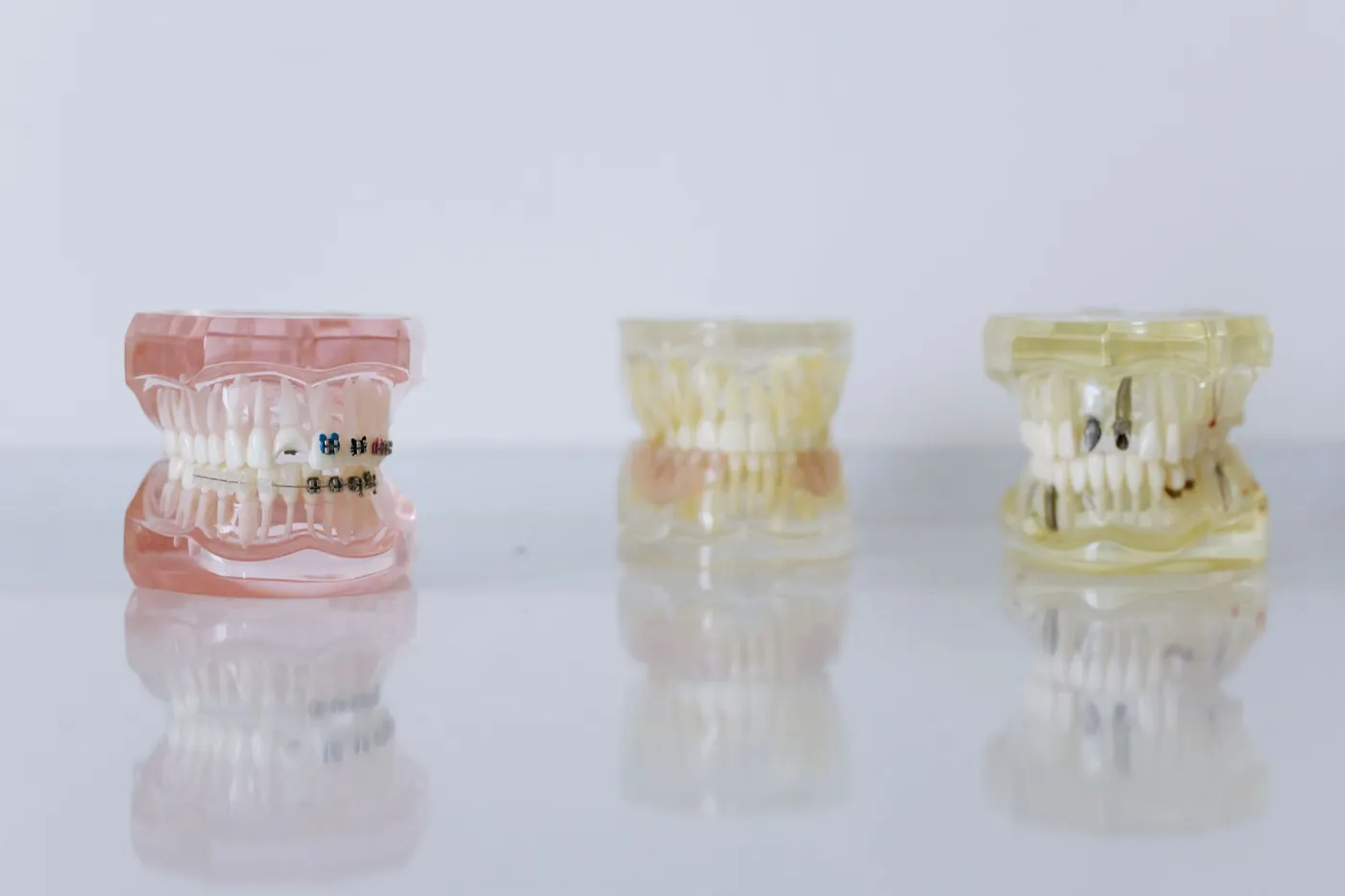 Are Fillings Covered by Health Insurance? The Conditions